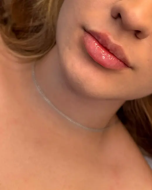 Resultado de preenchimento labial RC Lips