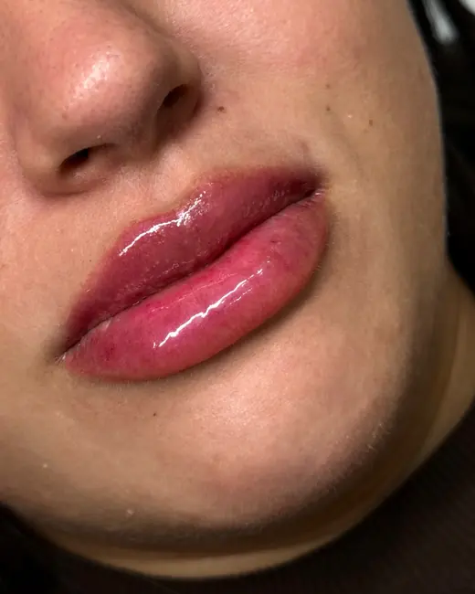 Resultado de preenchimento labial RC Lips