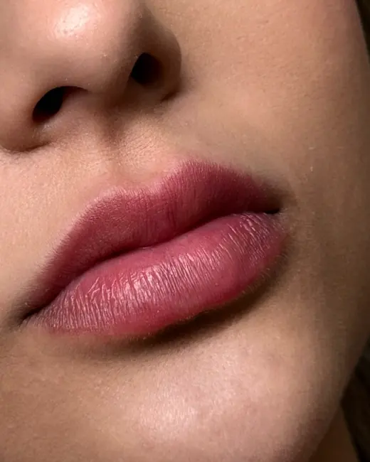 Resultado de preenchimento labial RC Lips