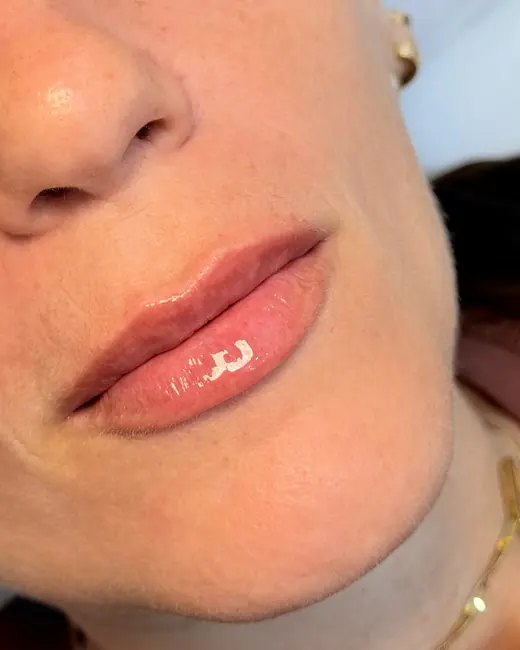 Resultado de preenchimento labial RC Lips
