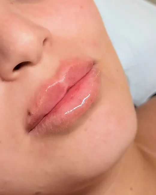 Resultado de preenchimento labial RC Lips