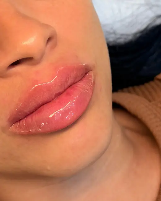 Resultado de preenchimento labial RC Lips