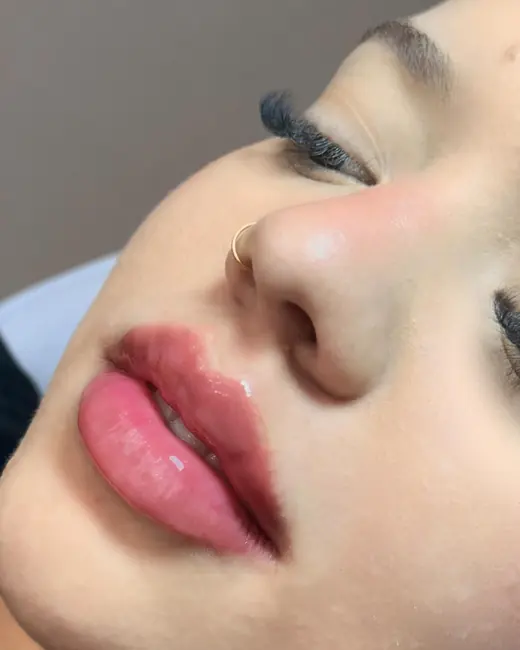 Resultado de preenchimento labial RC Lips
